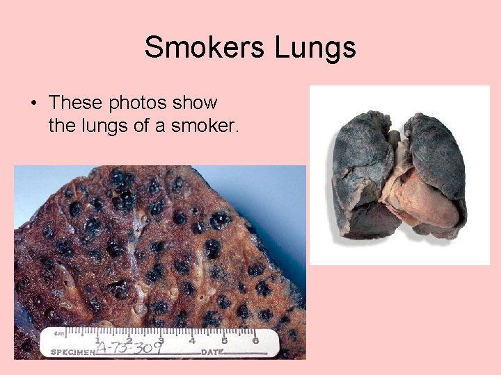 Smokers Lungs • These photos show the lungs of a smoker. 