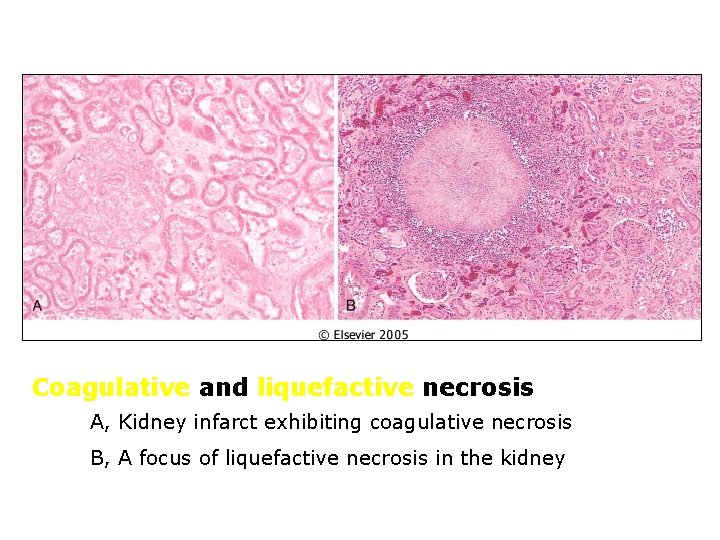 Coagulative and liquefactive necrosis A, Kidney infarct exhibiting coagulative necrosis B, A focus of