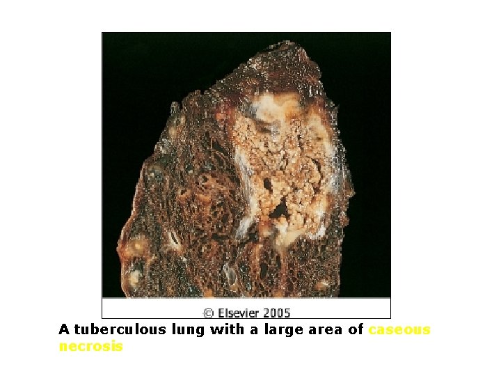 A tuberculous lung with a large area of caseous necrosis 