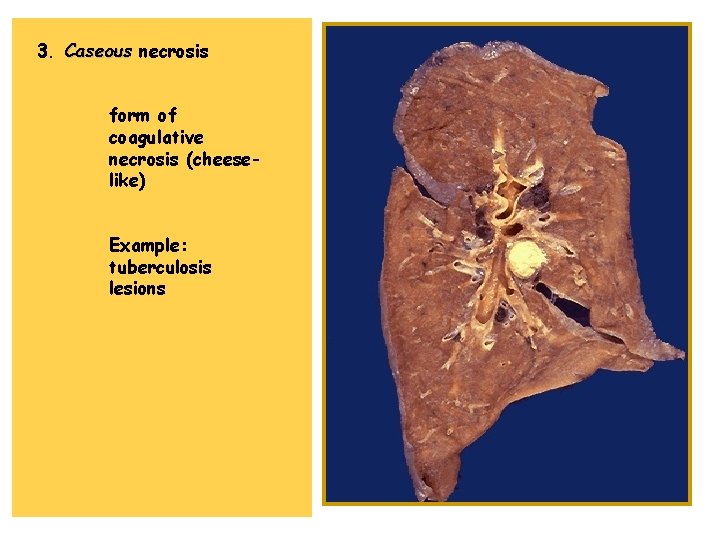 3. Caseous necrosis form of coagulative necrosis (cheeselike) Example: tuberculosis lesions 