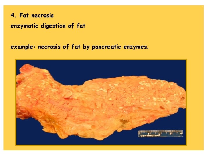 4. Fat necrosis enzymatic digestion of fat example: necrosis of fat by pancreatic enzymes.