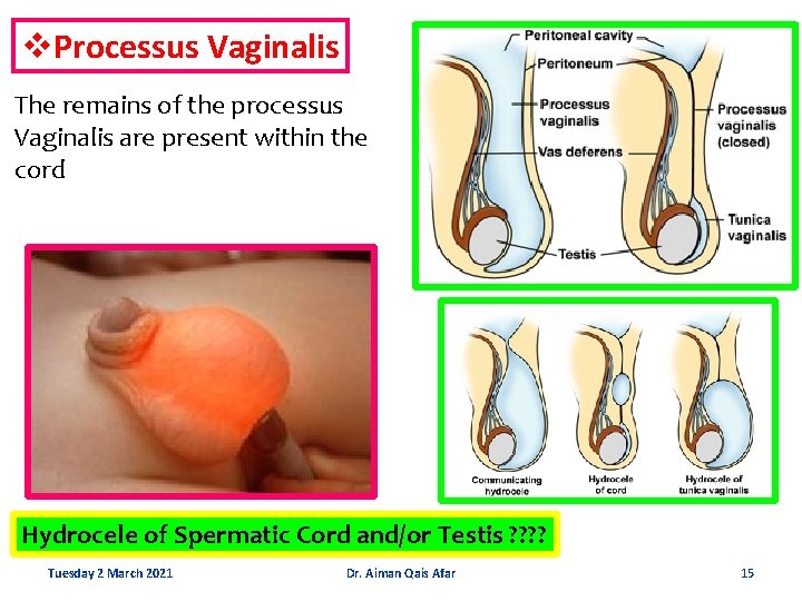 v. Processus Vaginalis The remains of the processus Vaginalis are present within the cord