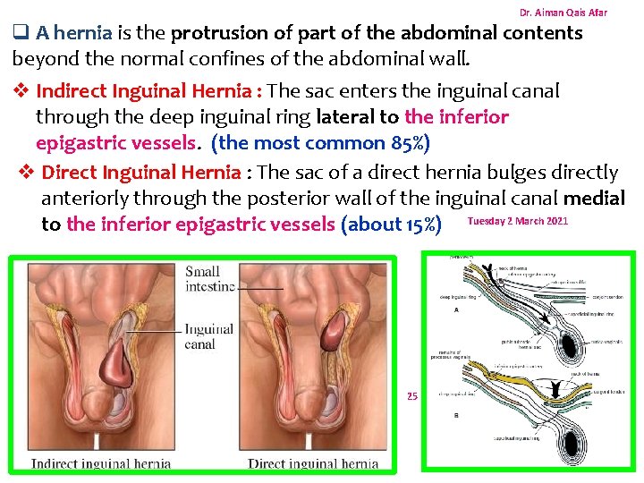 Dr. Aiman Qais Afar q A hernia is the protrusion of part of the