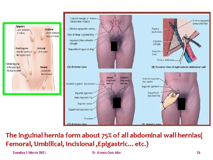 The inguinal hernia form about 75% of all abdominal wall hernias( Femoral, Umbilical, Incisional