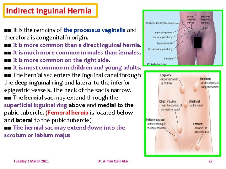 Indirect Inguinal Hernia ■■ It is the remains of the processus vaginalis and therefore
