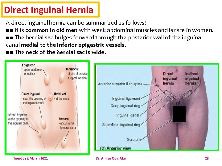 Direct Inguinal Hernia A direct inguinal hernia can be summarized as follows: ■■ It