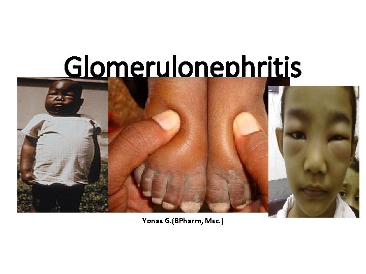 Glomerulonephritis Yonas G. (BPharm, Msc. ) 