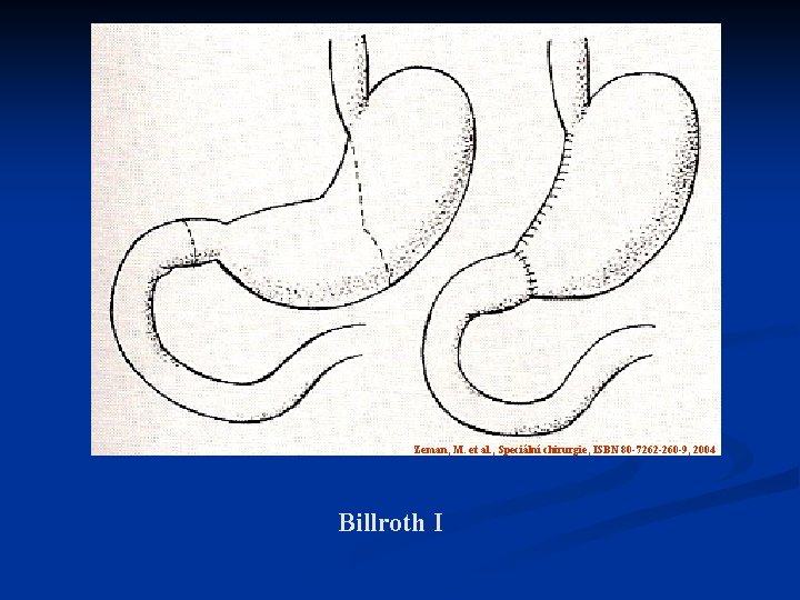 Zeman, M. et al. , Speciální chirurgie, ISBN 80 -7262 -260 -9, 2004 Billroth