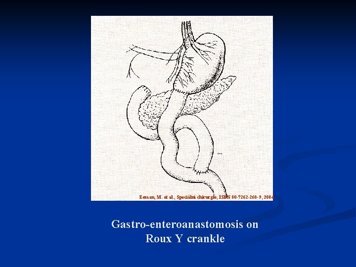 Zeman, M. et al. , Speciální chirurgie, ISBN 80 -7262 -260 -9, 2004 Gastro-enteroanastomosis