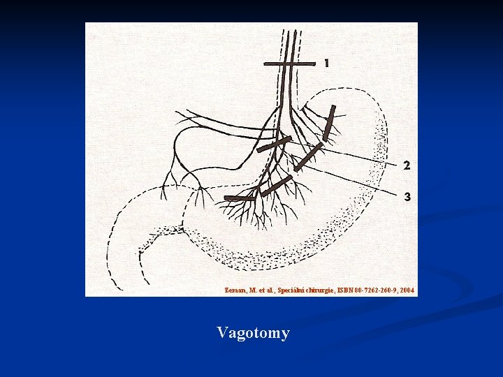 Zeman, M. et al. , Speciální chirurgie, ISBN 80 -7262 -260 -9, 2004 Vagotomy