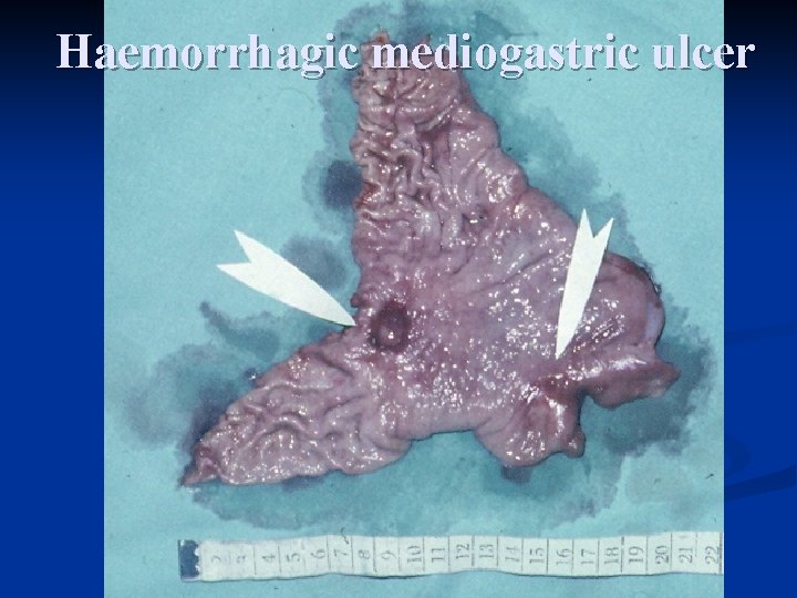 Haemorrhagic mediogastric ulcer 