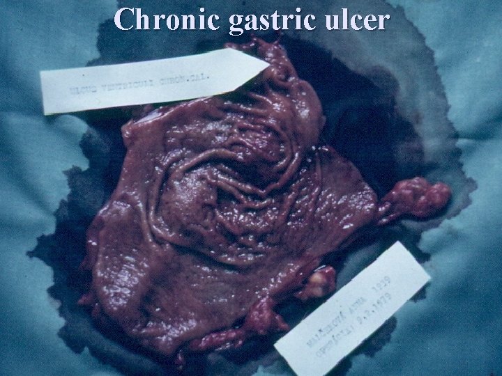 Chronic gastric ulcer 