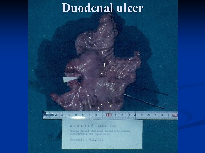 Duodenal ulcer 
