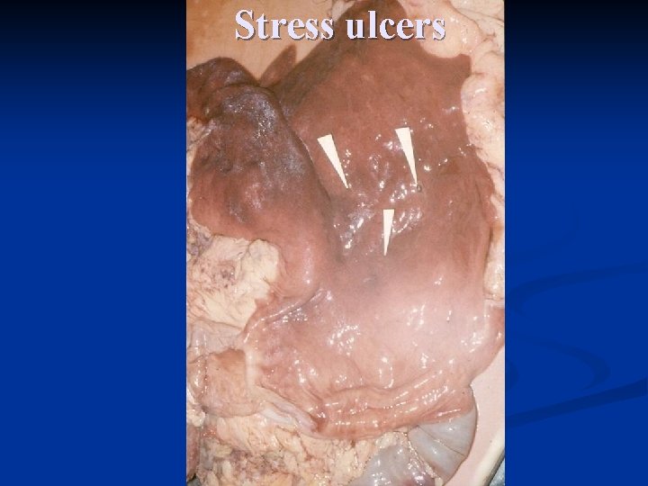 Stress ulcers 