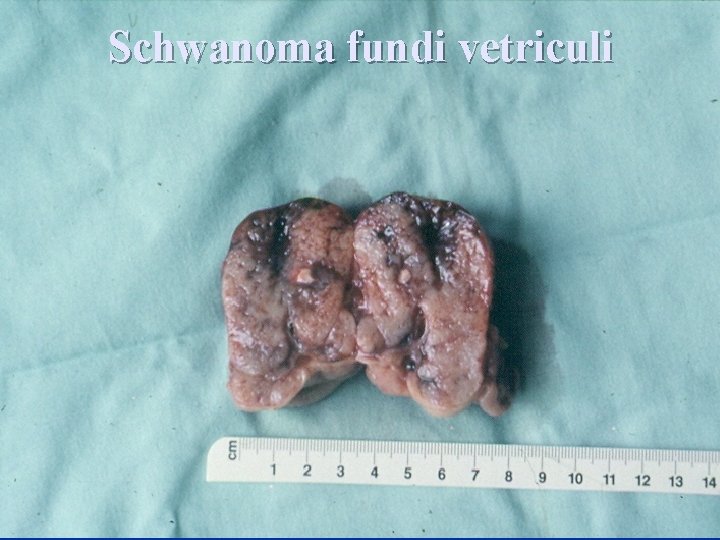 Schwanoma fundi vetriculi 