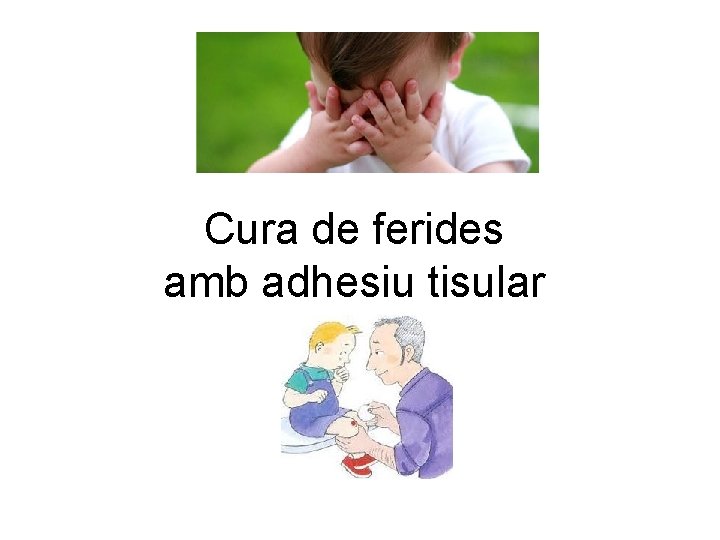 Cura de ferides amb adhesiu tisular 