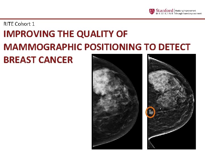 RITE Cohort 1 IMPROVING THE QUALITY OF MAMMOGRAPHIC POSITIONING TO DETECT BREAST CANCER 