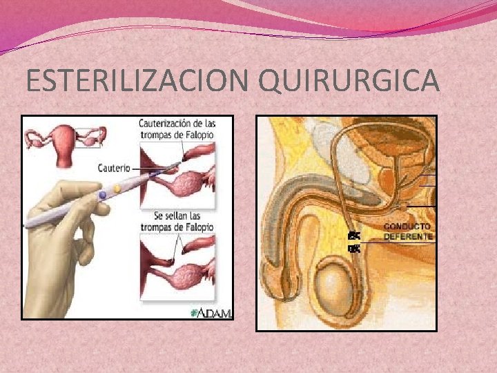 ESTERILIZACION QUIRURGICA 