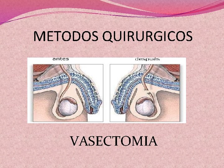 METODOS QUIRURGICOS VASECTOMIA 