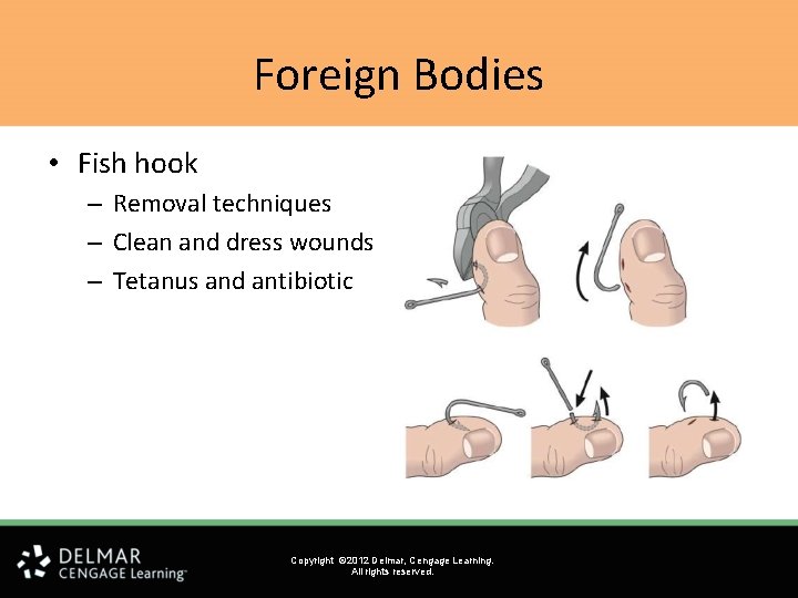 Foreign Bodies • Fish hook – Removal techniques – Clean and dress wounds –