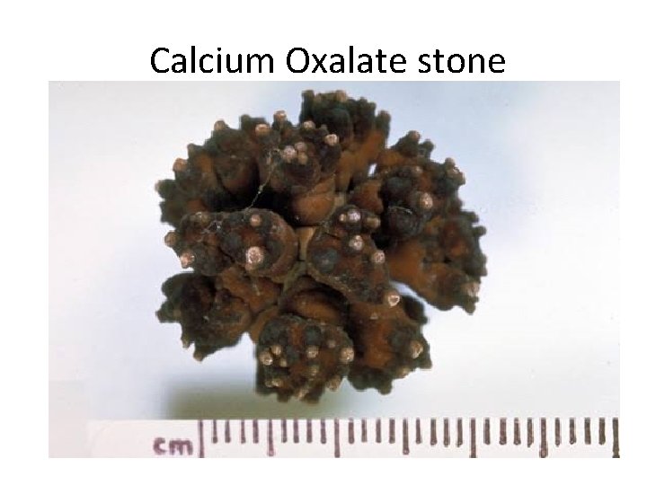 Calcium Oxalate stone 