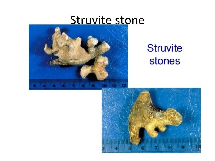 Struvite stone 