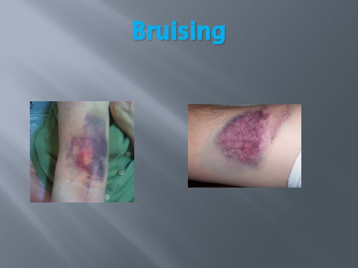 Bruising Bruising