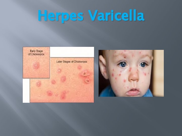 Herpes Varicella Herpes Varicella
