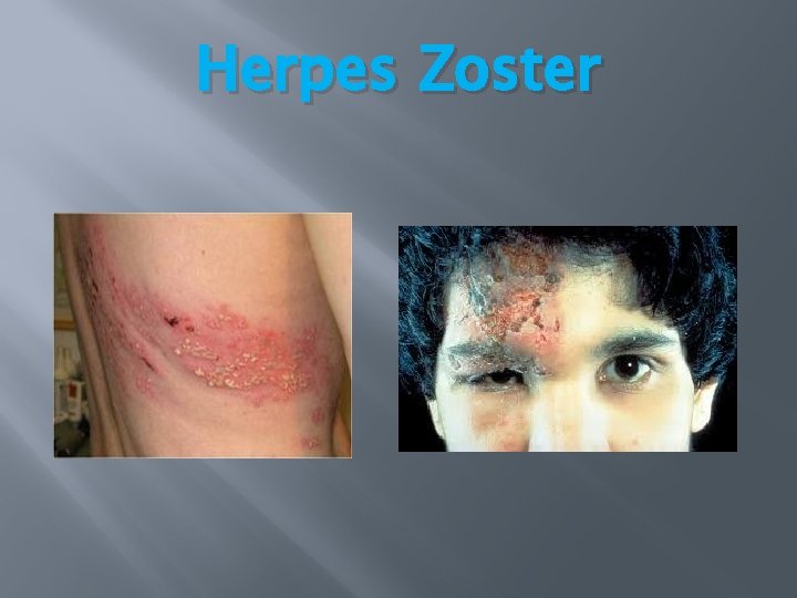 Herpes Zoster Herpes Zoster