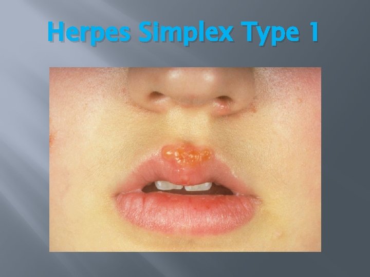 Herpes Simplex Type 1 Herpes Simplex Type 1