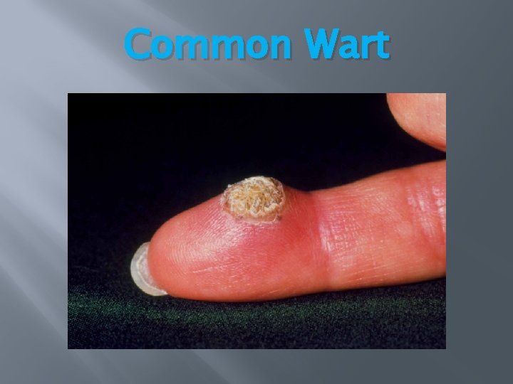 Common Wart Common Wart