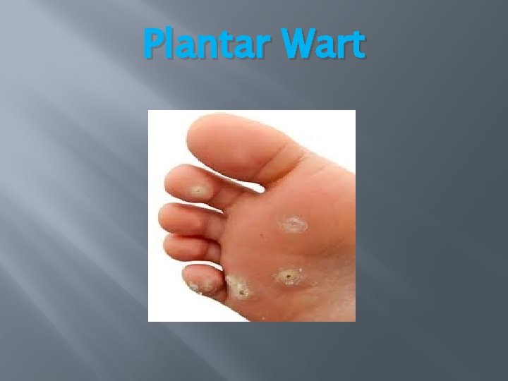 Plantar Wart Plantar Wart