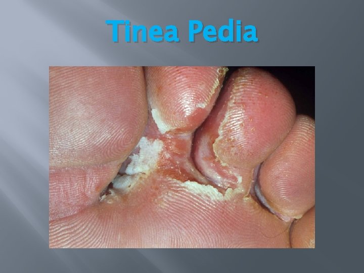 Tinea Pedia Tinea Pedia