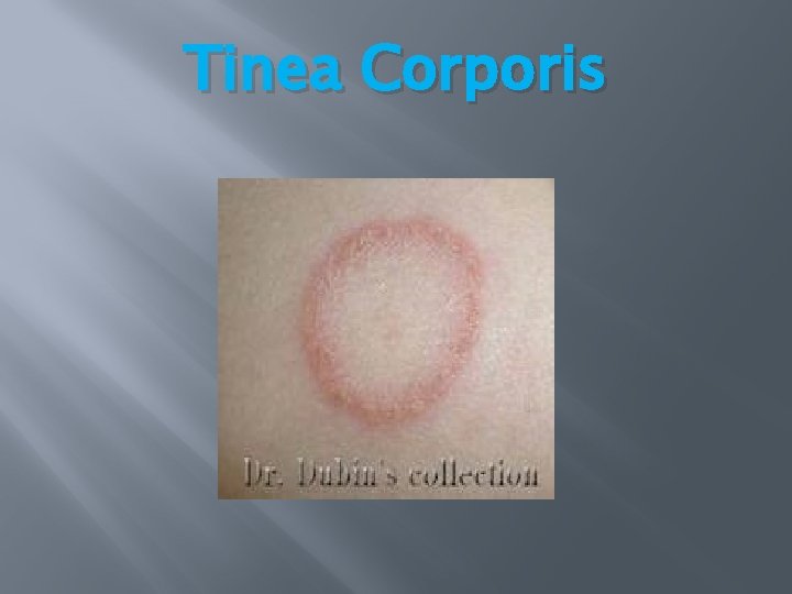Tinea Corporis Tinea Corporis