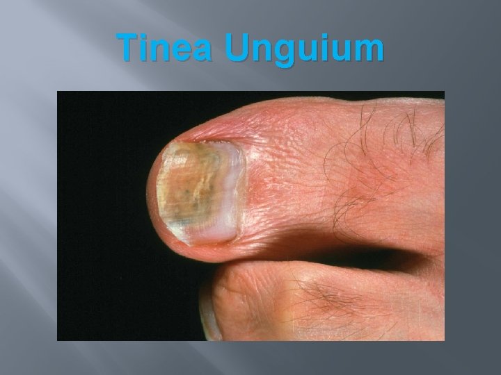 Tinea Unguium Tinea Unguium