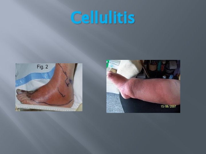 Cellulitis Cellulitis