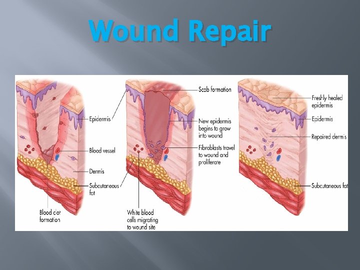 Wound Repair Wound Repair
