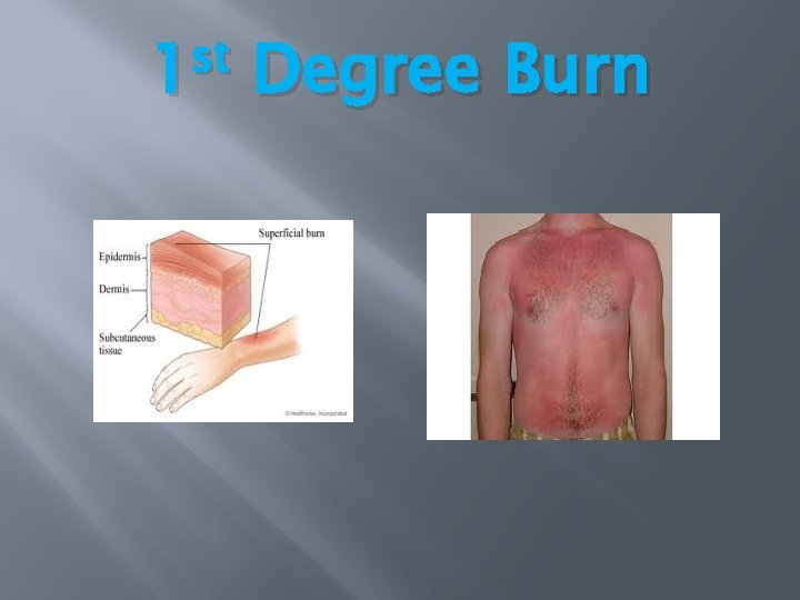 st 1 Degree Burn st 1 Degree Burn