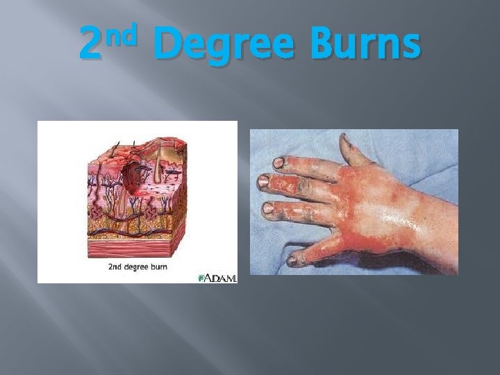 nd 2 Degree Burns nd 2 Degree Burns