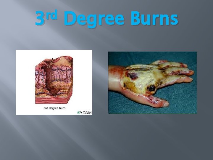 rd 3 Degree Burns rd 3 Degree Burns