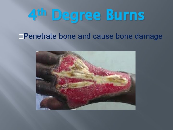 th 4 Degree Burns �Penetrate bone and cause bone damage th 4 Degree Burns �Penetrate bone and cause bone damage
