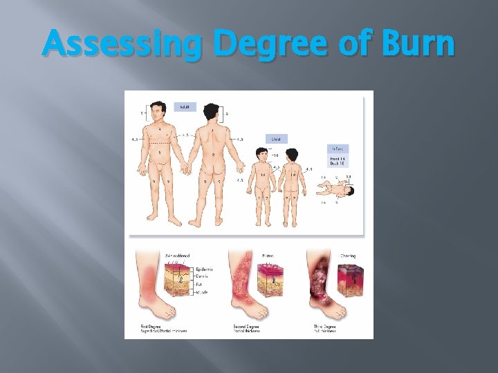 Assessing Degree of Burn Assessing Degree of Burn