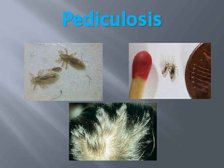 Pediculosis Pediculosis