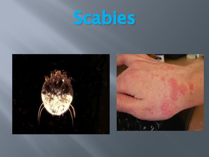Scabies Scabies