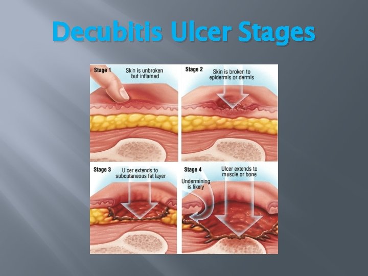 Decubitis Ulcer Stages Decubitis Ulcer Stages
