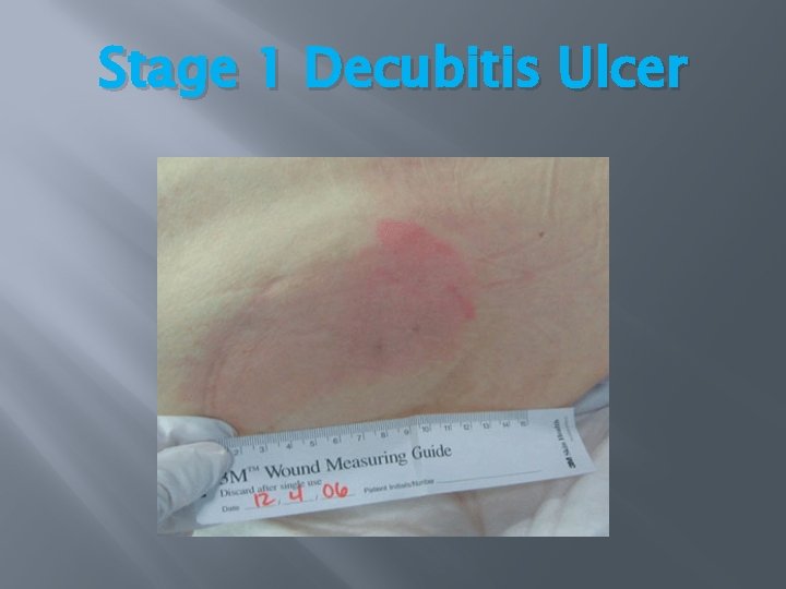 Stage 1 Decubitis Ulcer Stage 1 Decubitis Ulcer