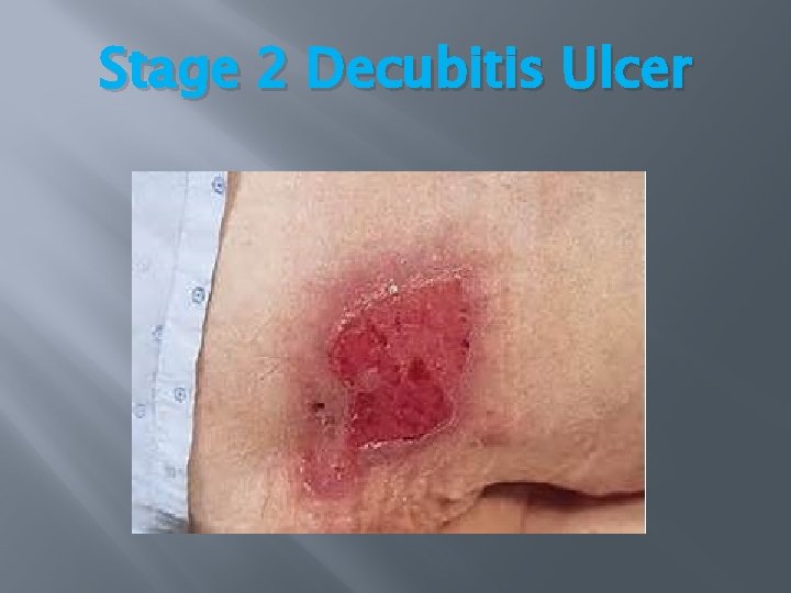 Stage 2 Decubitis Ulcer Stage 2 Decubitis Ulcer
