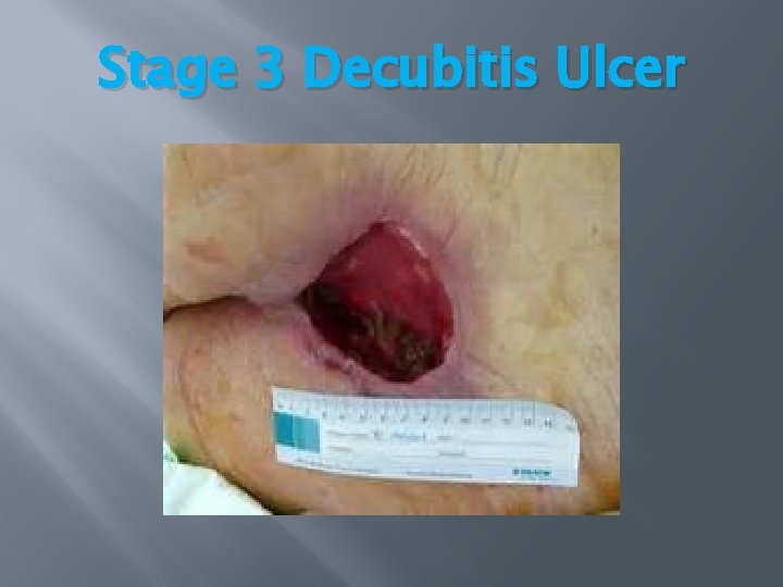 Stage 3 Decubitis Ulcer Stage 3 Decubitis Ulcer