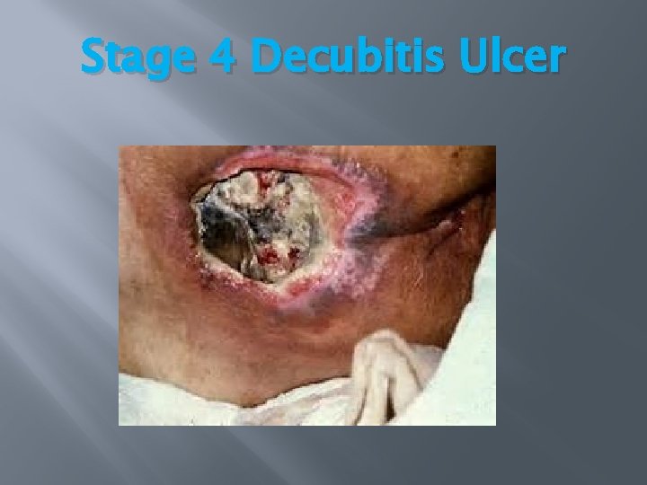 Stage 4 Decubitis Ulcer Stage 4 Decubitis Ulcer