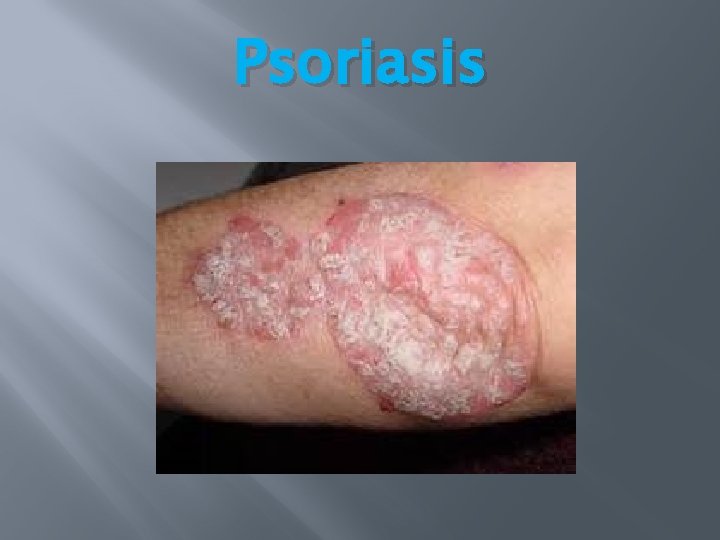 Psoriasis Psoriasis